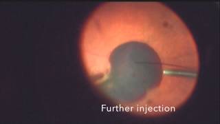 Submacular Tpa for large sub macular bleed in wet AMD [upl. by Constantin136]