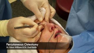 Percutaneous Osteotomy amp Breaking the Nose During Rhinoplasty Surgery [upl. by Ydnik]