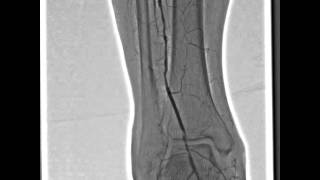 Angiography  Lower Extremities RSMDSA [upl. by Infield220]