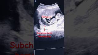 Subchorionic Hematomasubchorionic hemorrhage  1st trimester ultrasound ytshorts baby pregnancy [upl. by Ynohtnanhoj]