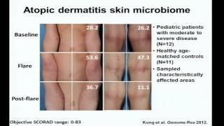 Eczema Immunity and the Skin Microbiome  Heidi Kong [upl. by Anni401]