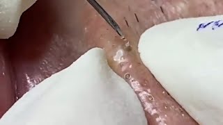 Painstaking Super Satisfying Pimple Relaxing Skincare [upl. by Gilliam539]