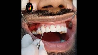 Smile Makeover  eMax veneers  zirconia  Aldaim Dental Center cosmeticdentistry [upl. by Bikales]