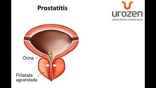 ¿Prostatitis que no es Prostatitis ¿Cistitis que no es Cistitis  Urología UROZEN [upl. by Jaret]