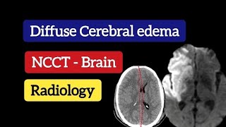 Diffuse Cerebral edema  CT Brain  Radiology [upl. by Tepper]