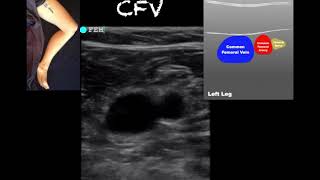 POCUS  Lower Extremity Deep Venous Thrombosis DVT  Updated [upl. by Ggerk]