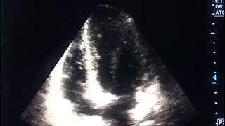 Myocarditis and echocardiographydrahmadmirdamadisiRSay4FU8O1HxWfD9 [upl. by Nabalas]