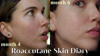 Roaccutane Daily Skin Diaries  Months 4  6  After The Purge Low Dose [upl. by Biddle706]