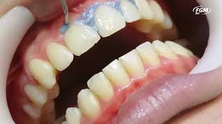 Caso clínico clareamento dental com Whiteness HP AutoMixx 35 PLUS e White Class 75 [upl. by Mariana281]