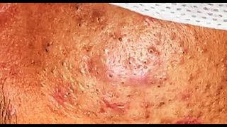 how to remove acne Blackheads and whiteheads it stay with him 5 years ago  Lymy nature 4 [upl. by Yztim]