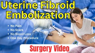 Uterine Fibroid Embolization  Surgery Video [upl. by Akihsat]