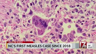 First measles case reported in NC since 2018 [upl. by Tuck]