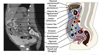 peritoneal and retroperitoneal spaces [upl. by Ammon]