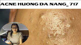 Acne Treatment Huong Da Nang 717  Remove Blackheads [upl. by Noeled163]