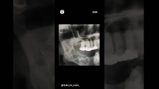 Ameloblastoma [upl. by Makell]