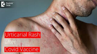 URTICARIAL RASH AFTER COVID VACCINE  How long does it last  Dr Surekha Tiwari  Doctors Circle [upl. by Watkins]