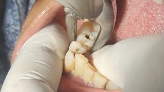 Braces Overbite Time lapse with extractions [upl. by Rois949]