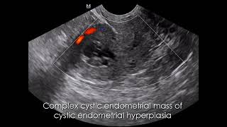 CASE 1096 cystic endometrial hyperplasia [upl. by Lemcke]