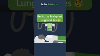 Benign vs Malignant Lung Nodules 🧐 USMLE MedicalEducation Radiology [upl. by Gauldin]