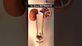 DJ Stent Removal  Retrograde Intrarenal Surgery  kidney stone treatment shorts [upl. by Ahsiuq784]