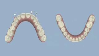 Invisalign  Midline Shift and IPR  Dr Thomas Gibbs DDS [upl. by Elodia404]