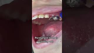 Remove the space maintainer baby teeth video tiktok trending dentist youtubeshorts shorts [upl. by Kellsie]