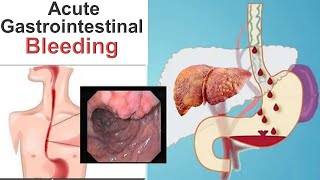 Acute Gastrointestinal Bleeding [upl. by Latsyc]