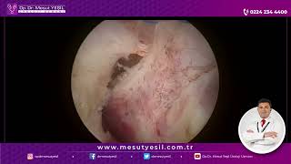 HoLEP Full Length Video 240 cc prostate Holmium Laser Enucleation of Prostate [upl. by Llibyc]