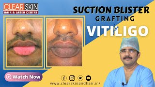 Suction Blister Grafting for Vitiligo  Surgical Treatments for Vitiligo by DrKailash  Clear Skin [upl. by Ahsenit]