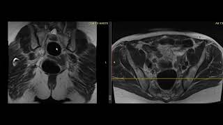 Worried about ovarian cancer What is the pelvic mass [upl. by Tamra]