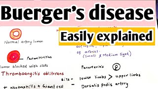 Buergers disease  Thromboangitis obliterans  Definition causes pathophysiology treatment [upl. by Lewis896]