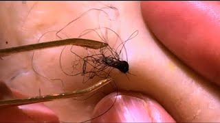 Removal of ingrown hair [upl. by Neenwahs616]