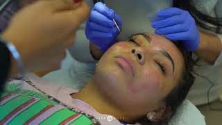 TCA Cross for Acne Scarring  Live with Dr Emer [upl. by Euqinahs]