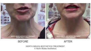 Botox Treatment Neck Platysmal Muscles Before amp After Video [upl. by Inna735]