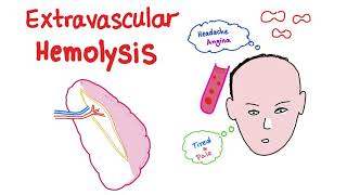 Extravascular Hemolysis [upl. by Attiuqihc]