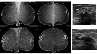 Breast Pathology  Infiltrating Lobular Carcinoma ILC [upl. by Meibers]