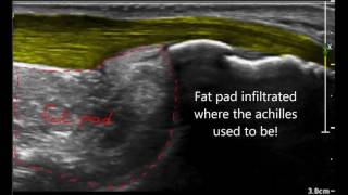 Haglund deformity versus haglund syndrome [upl. by Keil647]