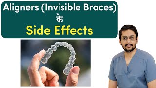 Aligners Invisible Braces के Side Effects  Dr Ankit  Seraphic Dental Indore [upl. by Rednal]