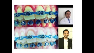 BLANQUEAMIENTO DENTAL CON BRACKETS ES POSIBLE FT TU DENTISTA DE CONFIANZA [upl. by Hamfurd927]