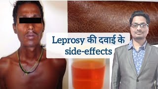 Leprosy की दवाइयों के sideeffects  Dapsone  Clofazimine  Rifampicin  Hansens disease leprosy [upl. by Oby787]