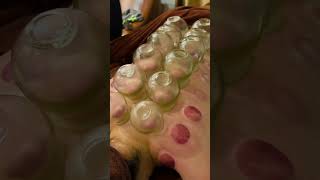 ASMR 拔罐 按摩  Cupping Therapy asmr cupping china therapy [upl. by Yremrej]