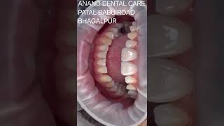 Want a better colour of your teeth go ahead with veneer or caping for your tooth  Anand Dental care [upl. by Otsirc]