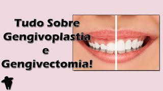 Aula de Periodontia  Tudo Sobre Gengivoplastia e Gengivectomia  Indicações e Passo a Passo [upl. by Aelanna202]