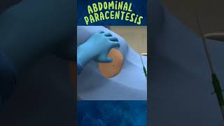 Abdominal Paracentesis 3D Animation Pait Se Pani Nikalna [upl. by Sulokcin]