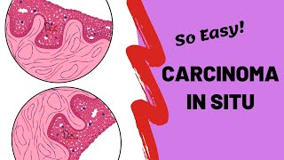 Carcinoma in Situ  ORAL PATHOLOGY [upl. by Riffle909]