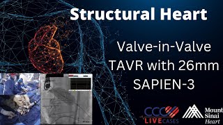 ValveinValve TAVR with 26mm SAPIEN3  March 2019 [upl. by Chara]