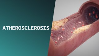 Atherosclerosis  Pathologies [upl. by Silverstein]