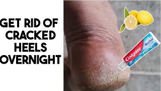 SUPER THICK HARD SKIN SCRAPING  Callous Removal From Feet  Full Treatment By Miss Foot Fixer [upl. by Tawsha]