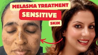 Melasma Treatment for Sensitive skin  Melasma Skincare Routine  Nipun Kapur [upl. by Haonam]