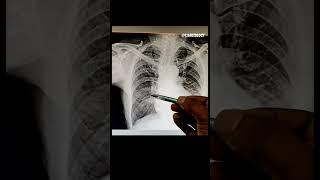 Chest finding x ray of chest cardiomegaly [upl. by Doherty858]